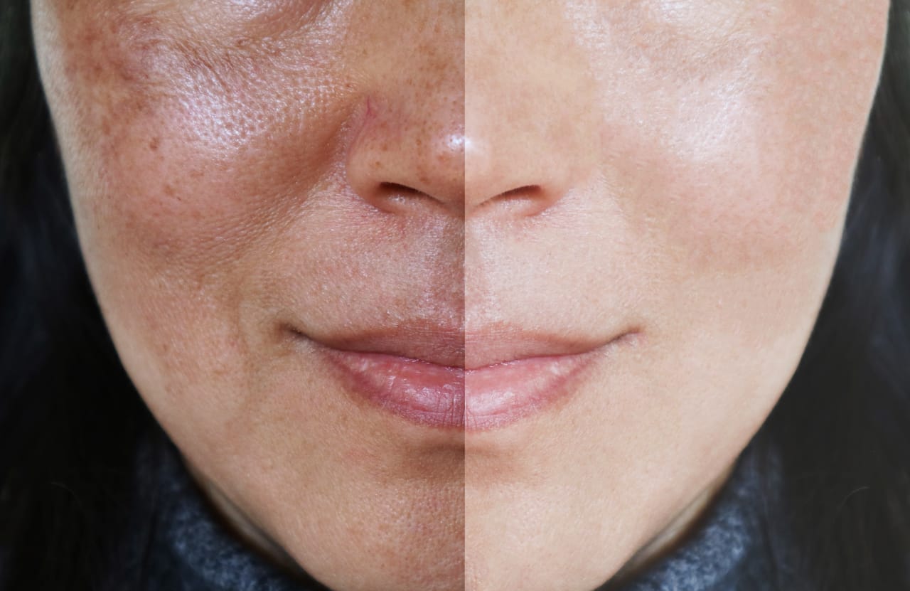 Melasma – Causes And Prevention Options