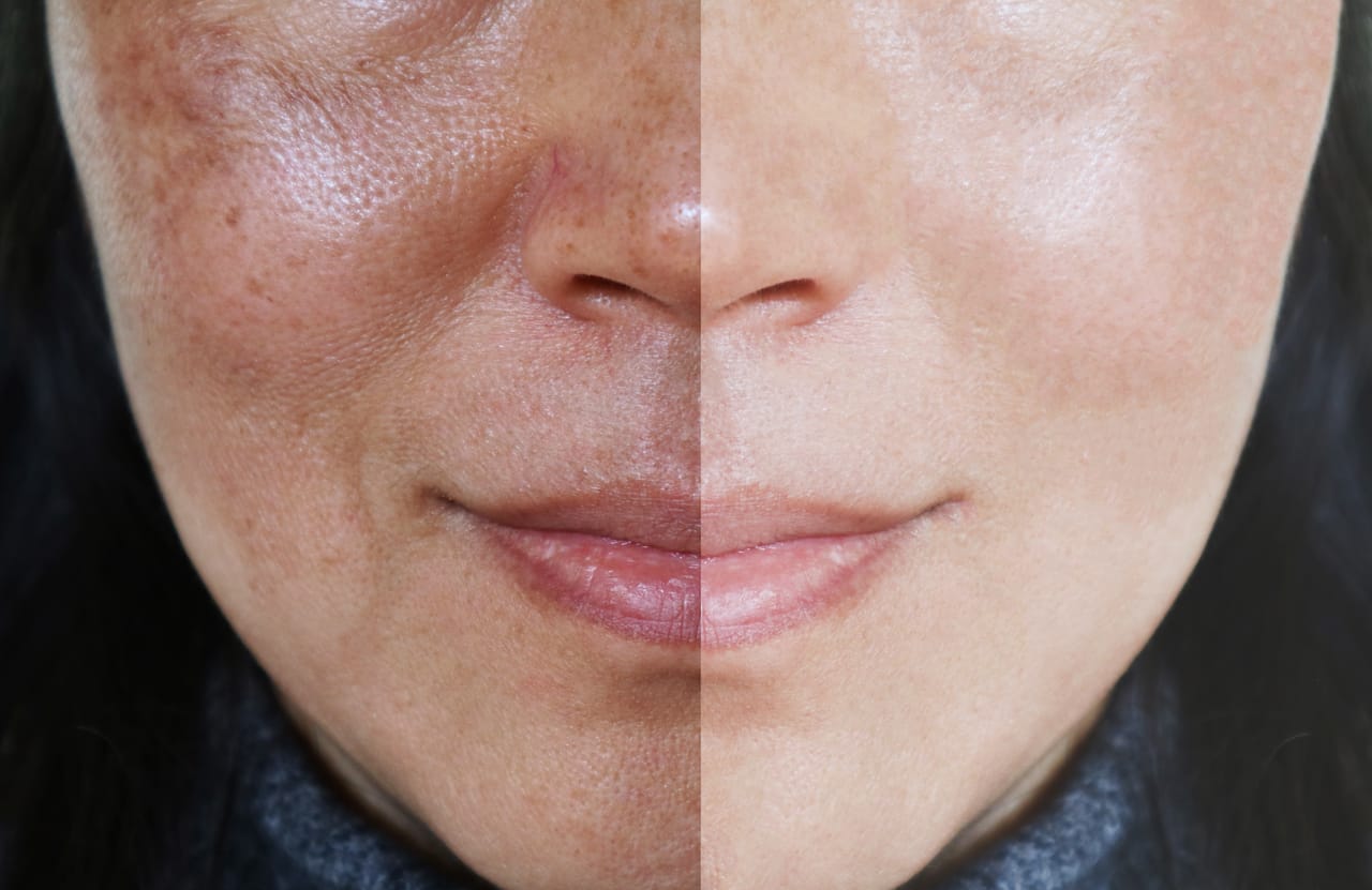 melasma-before-after