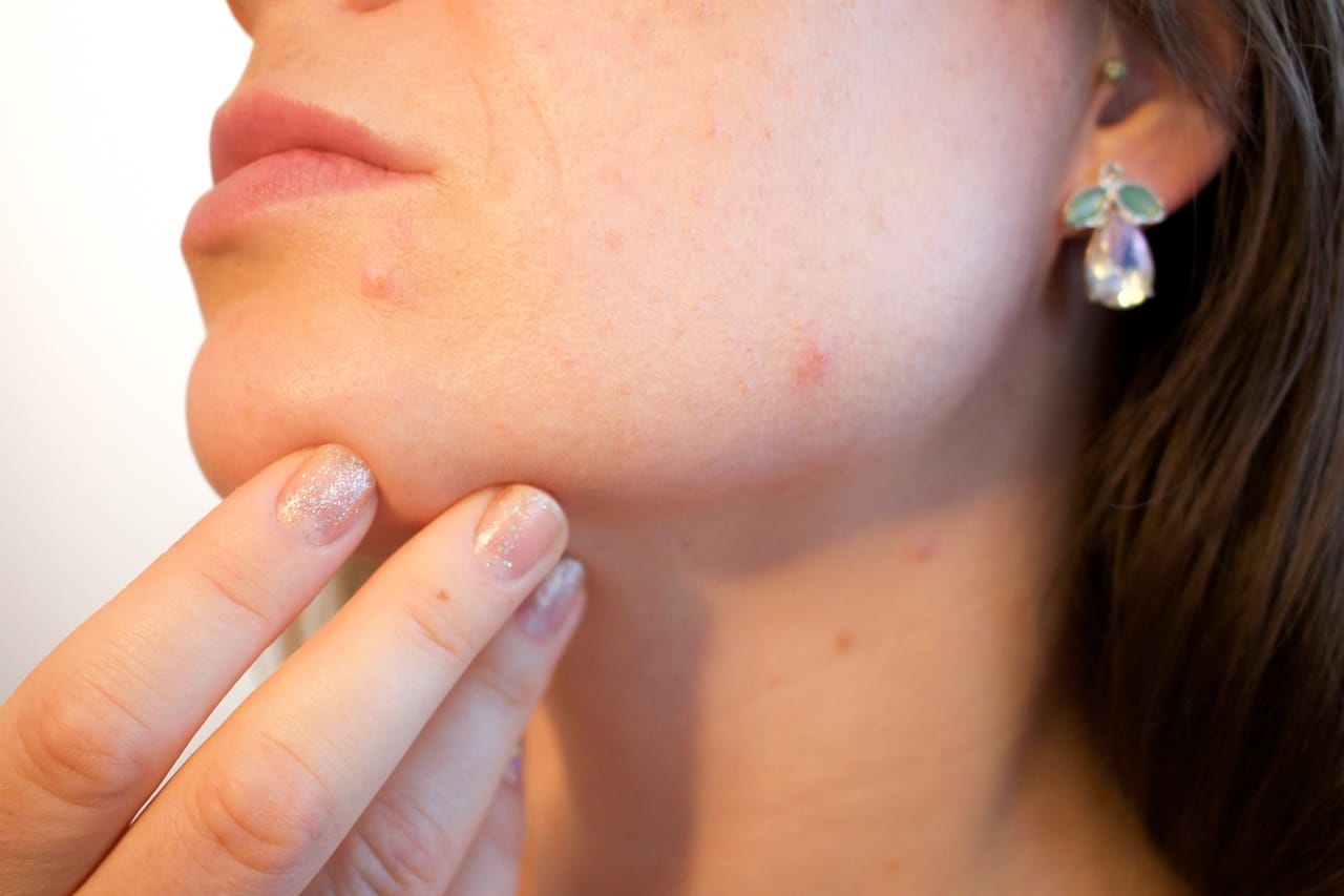 woman-with-acne-on-face